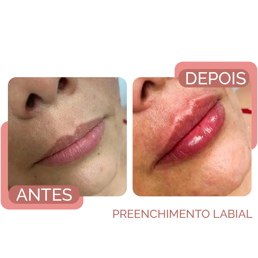 facial recife