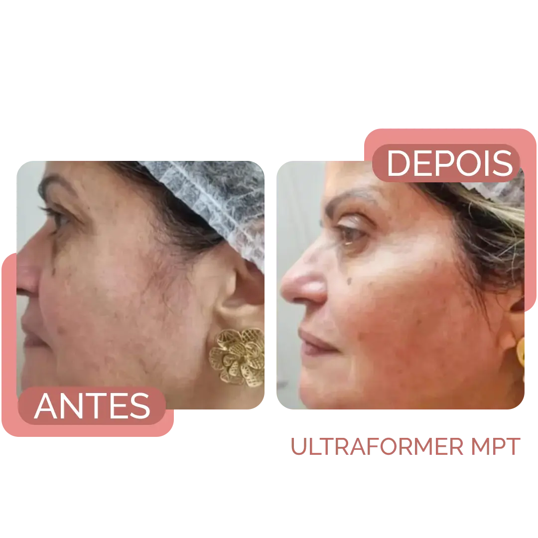 rejuvesnecimento facial