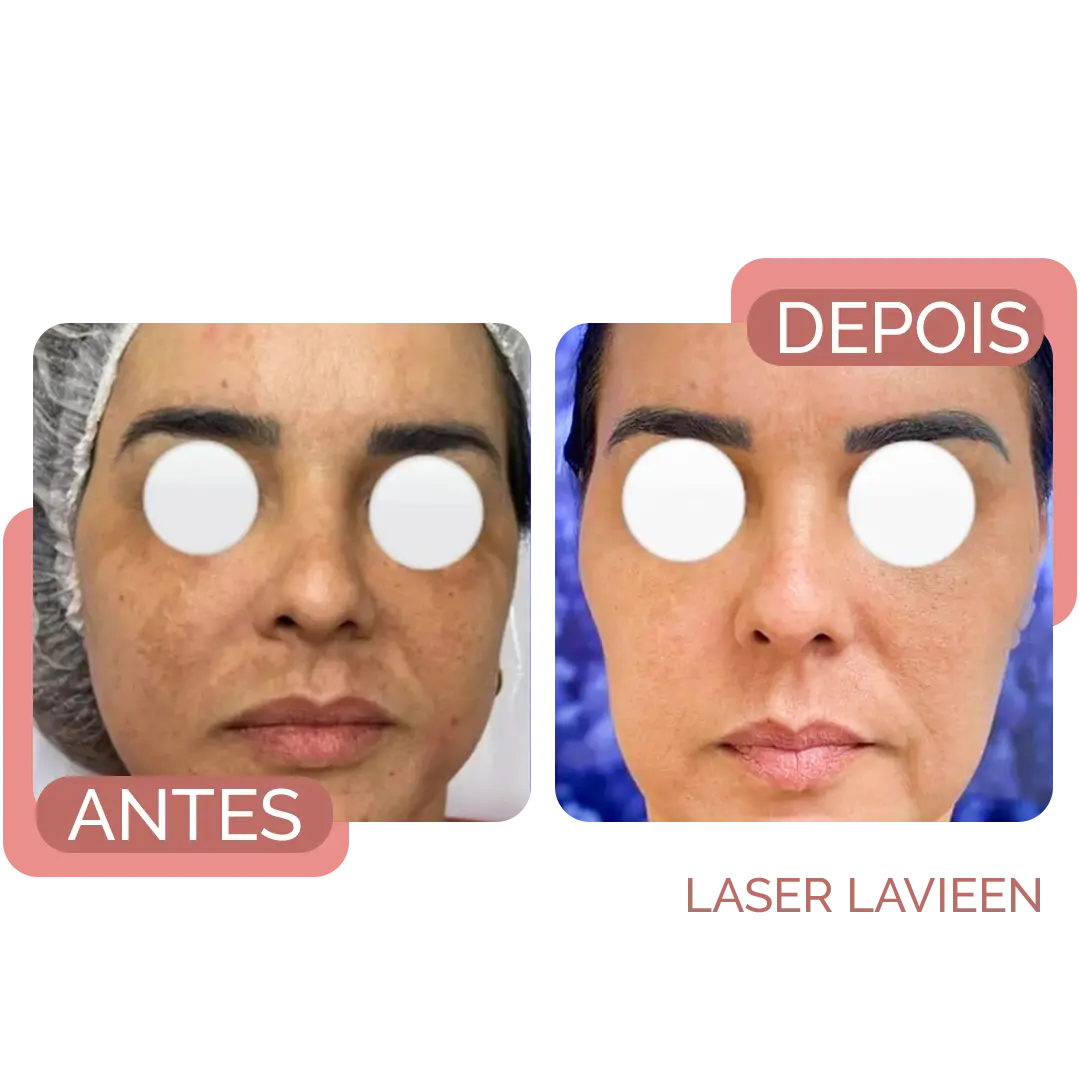 rejuvesnecimento facial corporal recife